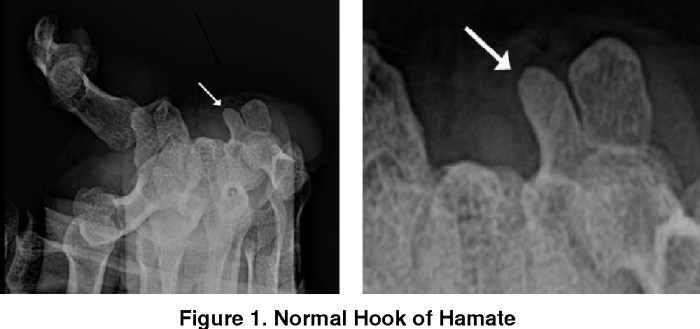 Carpal tunnel x ray positioning