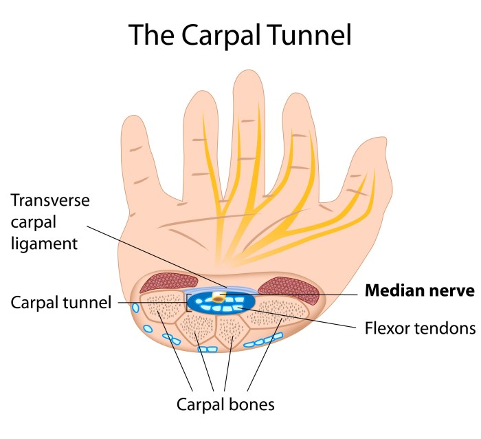 Wrist tunnel carpal syndrome synovectomy stress repetitive arthroscopic professionals dental ergonomics prevent injuries surgical cts matters why their serious diagnosis